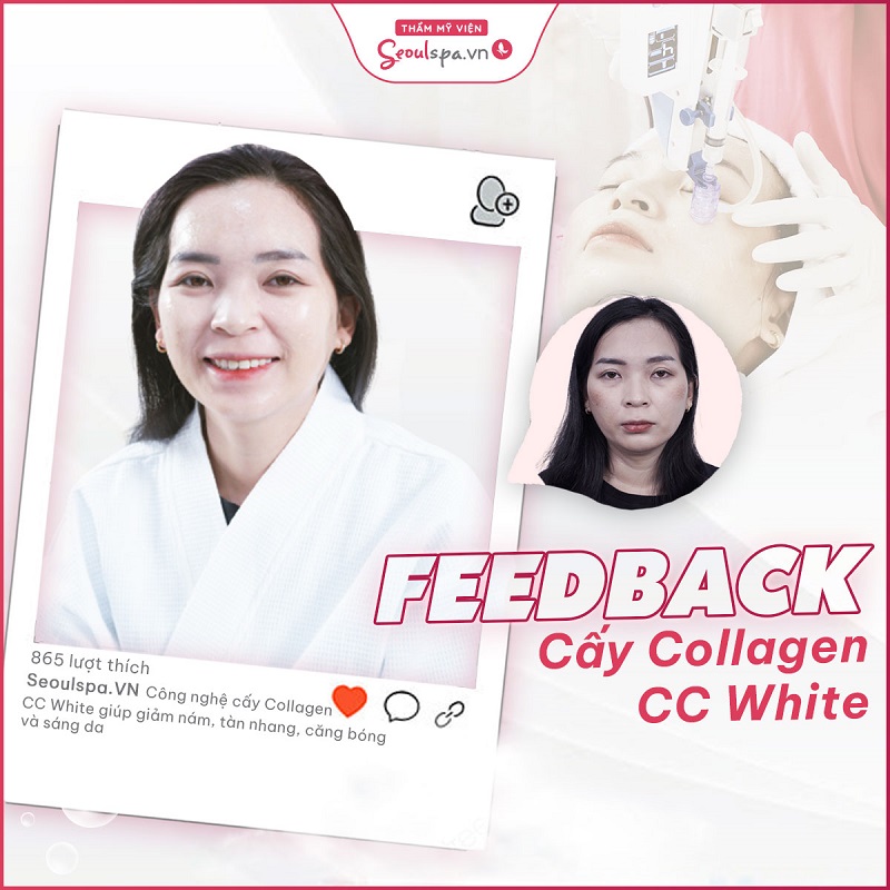Làn da trắng sáng, trẻ trung của khách hàng sau khia thực hiện cấy collagen tươi CC White tại Seoul Spa