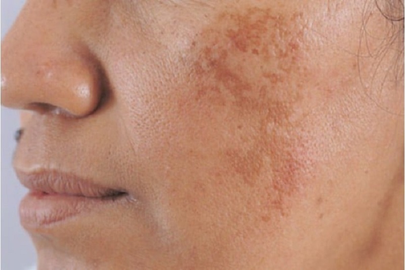 Làn da bị tăng sắc tố dẫn đến nám da