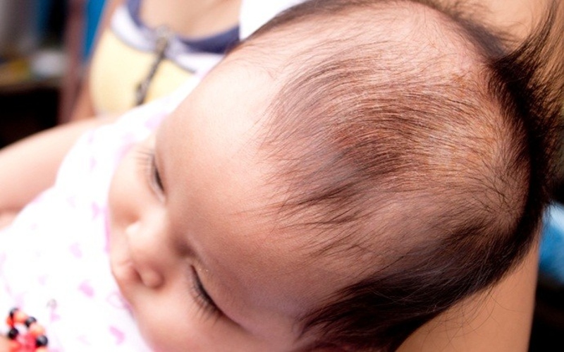 Rụng tóc trên đỉnh đầu diễn ra do hóc môn kích thích mọc tóc đột ngột giảm sau khi ra đời