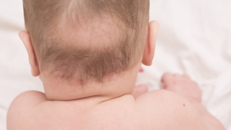 Rụng tóc vành khăn có thể là dấu hiệu cho thấy bé bị còi xương