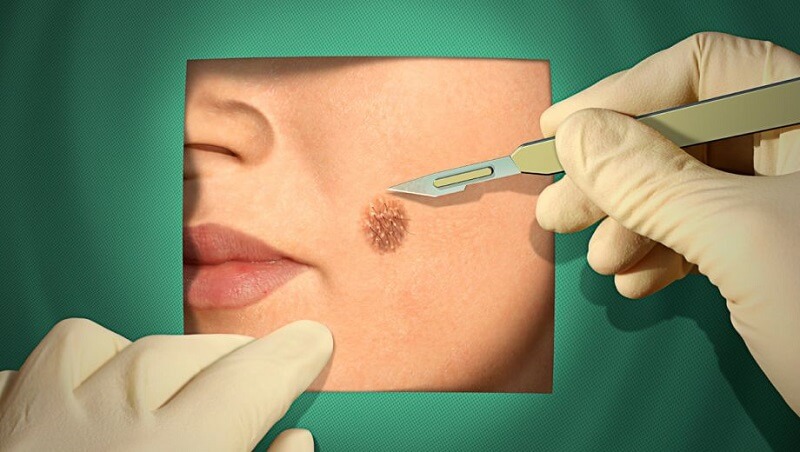 Tiểu phẫu được áp dụng với tình trạng nốt ruồi to, ăn sâu vào da và đen