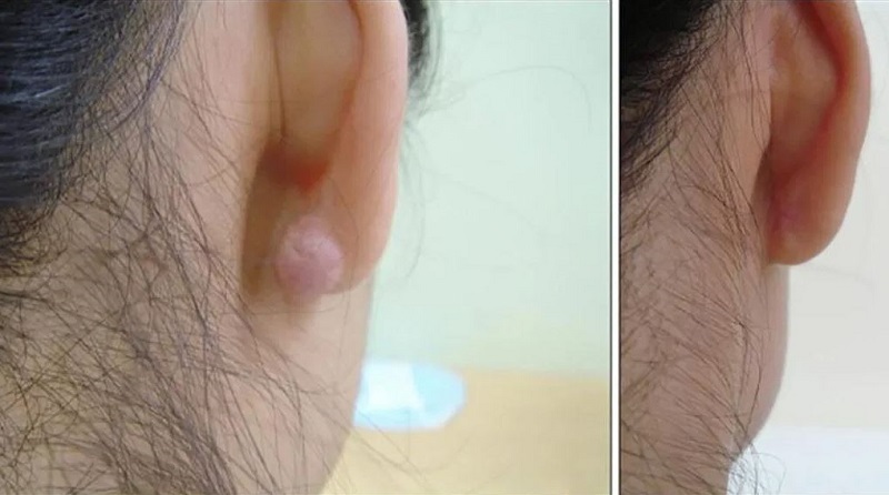 Sẹo lồi là hệ quả của tình trạng chăm sóc da không cẩn thận sau khi bị vết thương hở