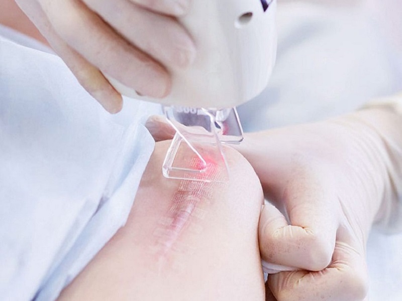Công nghệ laser đảm bảo an toàn, hiệu quả và không tổn thương nặng nề đến làn da