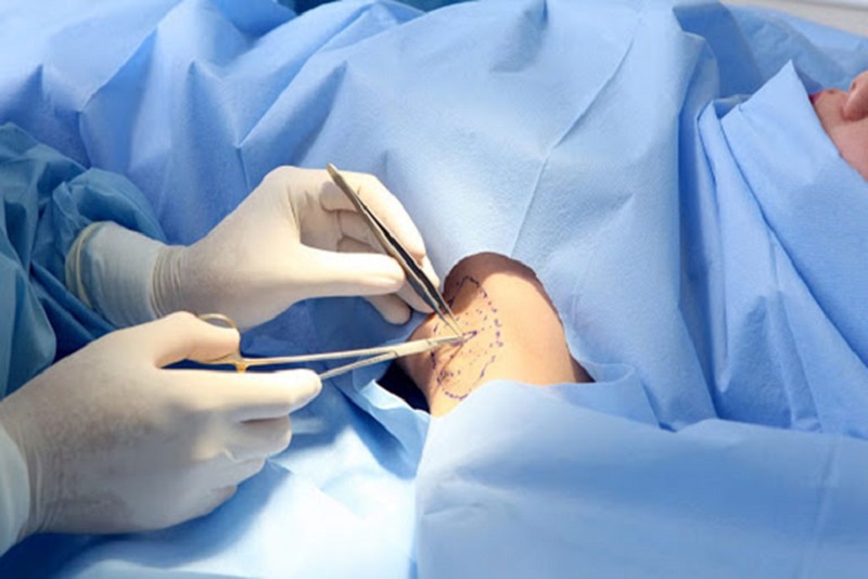 Phẫu thuật cắt tuyến mồ hôi nách giúp loại bỏ tận gốc mùi hôi