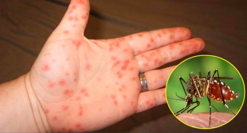 Hầu hết người bệnh sốt xuất huyết đều bị nổi chấm đỏ trên da