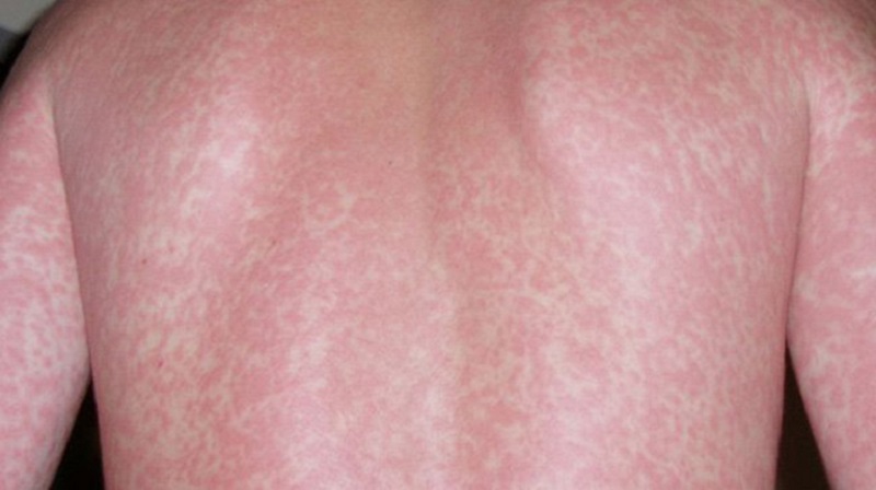 Da bị nổi chấm đỏ li ti khắp người khi bị sốt phát ban