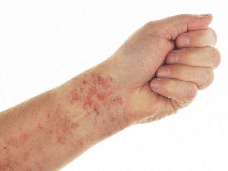 Người bệnh suy tủy bị xuất huyết dưới da xuất hiện nhiều chấm đỏ li ti
