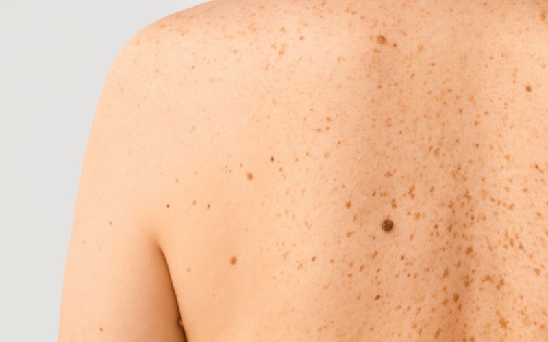 Da nổi chấm đỏ không ngứa do thay đổi sắc tố da thường không nguy hiểm