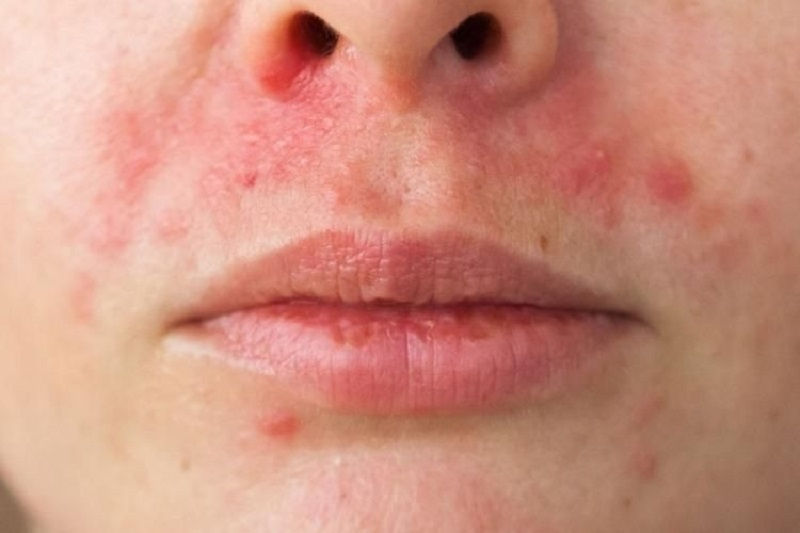 Nhổ râu sai cách sẽ khiến vùng da quanh miệng bị tổn thương