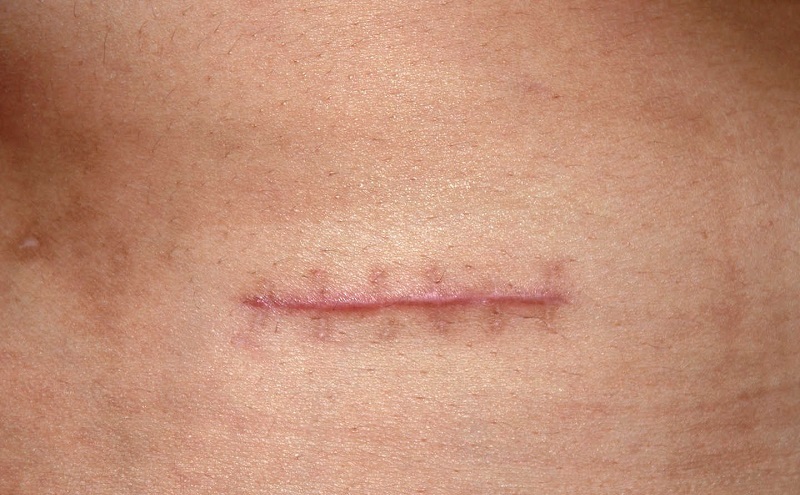 Vì phải khâu nên dù được xử lý gọn gàng, vùng da sau phẫu thuật cũng dễ bị sẹo lồi màu đỏ hồng