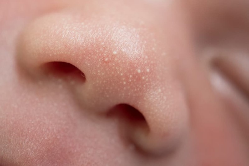 Mụn sữa thường xuất hiện ở cánh mũi trẻ sơ sinh